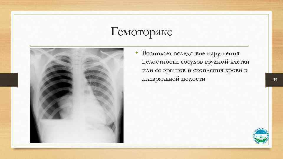 Гемоторакс • Возникает вследствие нарушения целостности сосудов грудной клетки или ее органов и скопления
