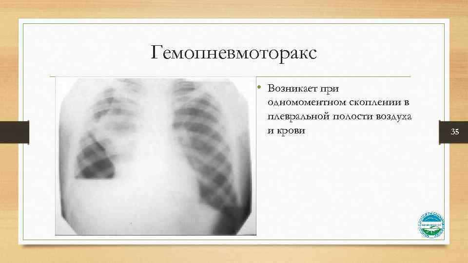 Гемопневмоторакс • Возникает при одномоментном скоплении в плевральной полости воздуха и крови 35 
