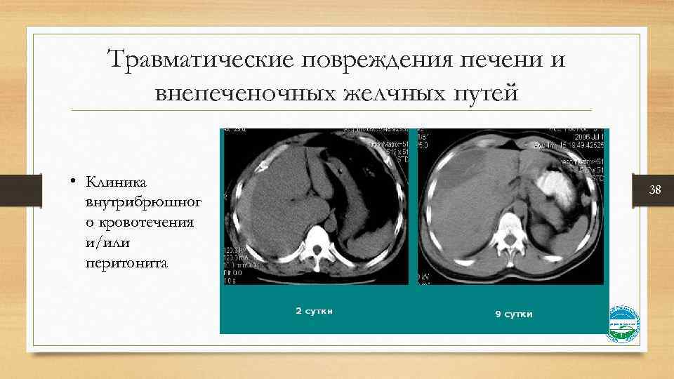 Травматические повреждения печени и внепеченочных желчных путей • Клиника внутрибрюшног о кровотечения и/или перитонита