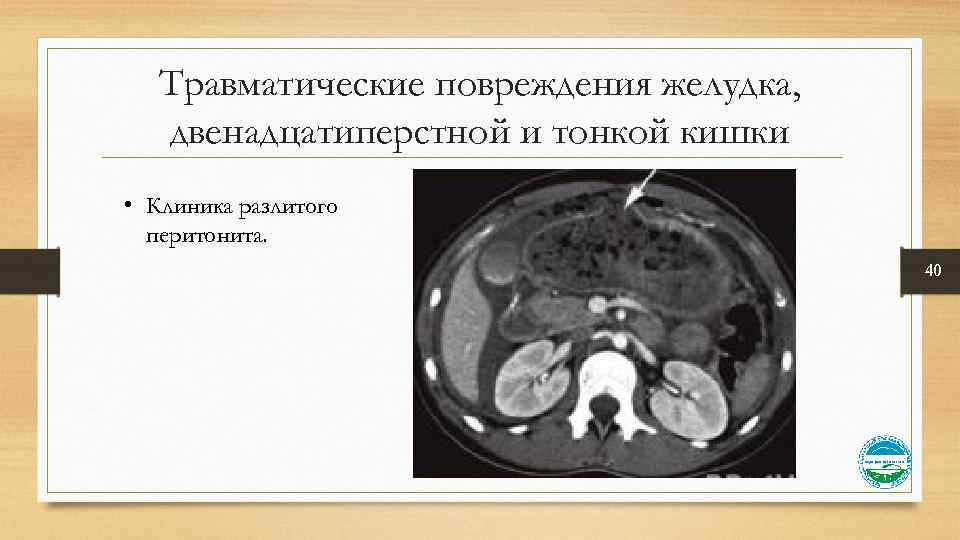 Травматические повреждения желудка, двенадцатиперстной и тонкой кишки • Клиника разлитого перитонита. 40 