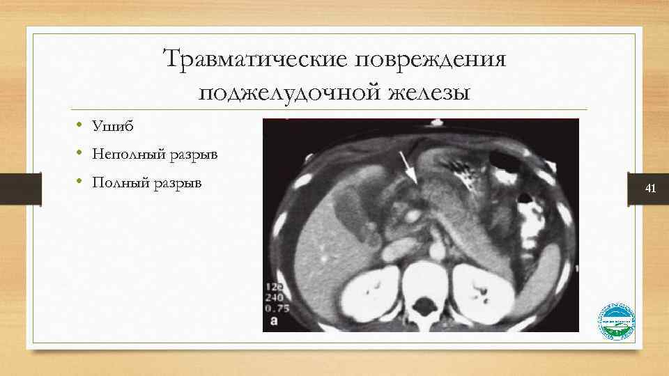 Травматические повреждения поджелудочной железы • Ушиб • Неполный разрыв • Полный разрыв 41 