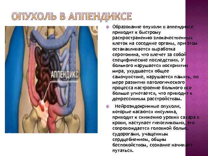  Образование опухоли в аппендиксе приводит к быстрому распространению злокачественных клеток на соседние органы,