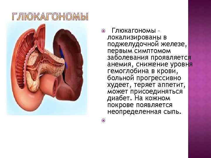  Глюкагономы – локализированы в поджелудочной железе, первым симптомом заболевания проявляется анемия, снижение уровня