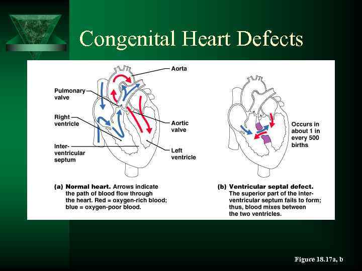 Congenital Heart Defects Figure 18. 17 a, b 