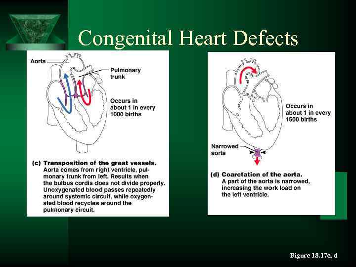 Congenital Heart Defects Figure 18. 17 c, d 