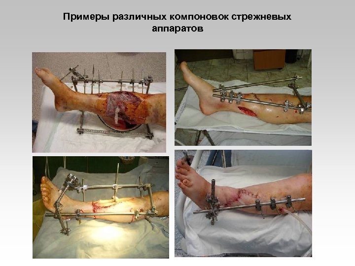 Примеры различных компоновок стрежневых аппаратов 