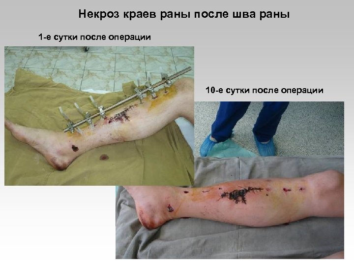 Некроз краев раны после шва раны 1 -е сутки после операции 10 -е сутки