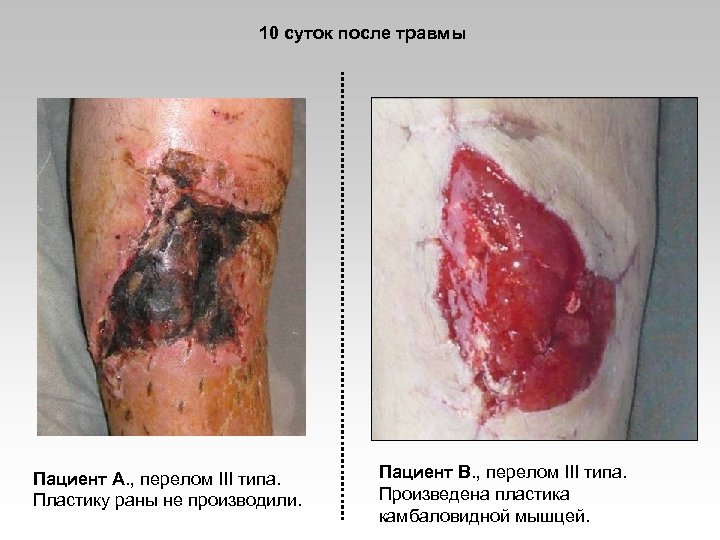 10 суток после травмы Пациент А. , перелом III типа. Пластику раны не производили.