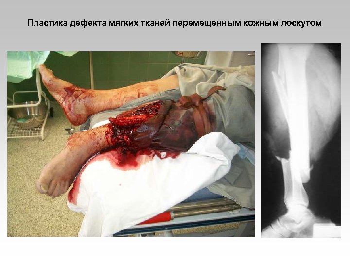 Пластика дефекта мягких тканей перемещенным кожным лоскутом 