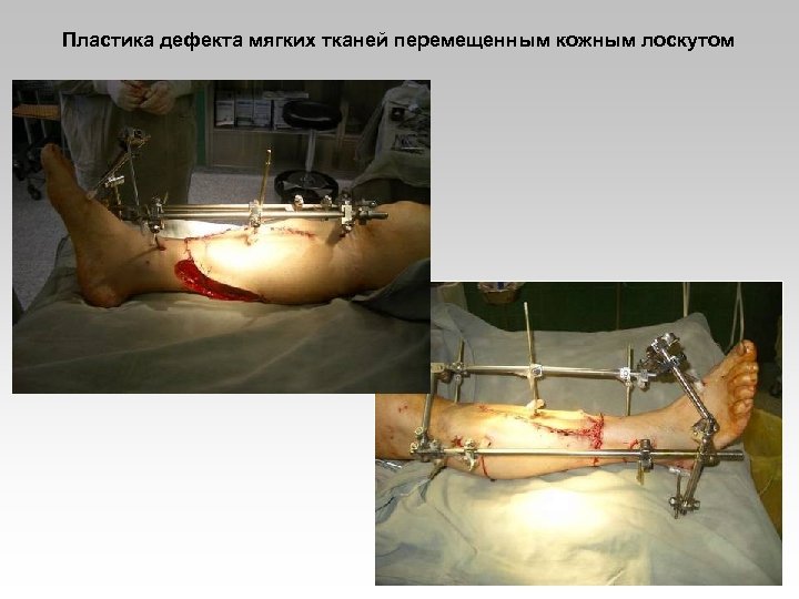 Пластика дефекта мягких тканей перемещенным кожным лоскутом 