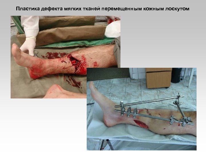 Пластика дефекта мягких тканей перемещенным кожным лоскутом 