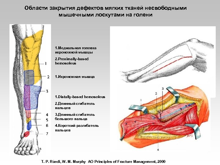Области закрытия дефектов мягких тканей несвободными мышечными лоскутами на голени 1. Медиальная головка икроножной