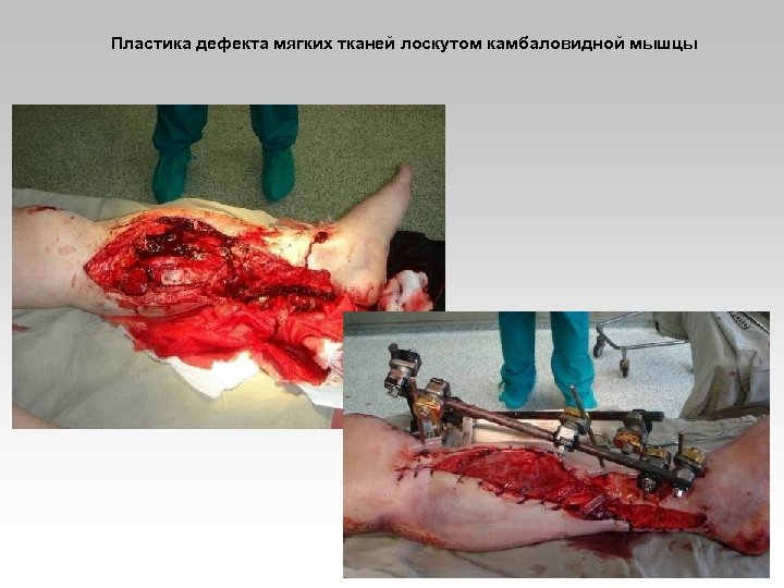 Пластика дефекта мягких тканей лоскутом камбаловидной мышцы 
