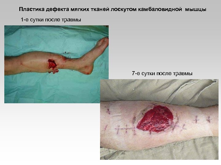Пластика дефекта мягких тканей лоскутом камбаловидной мышцы 1 -е сутки после травмы 7 -е