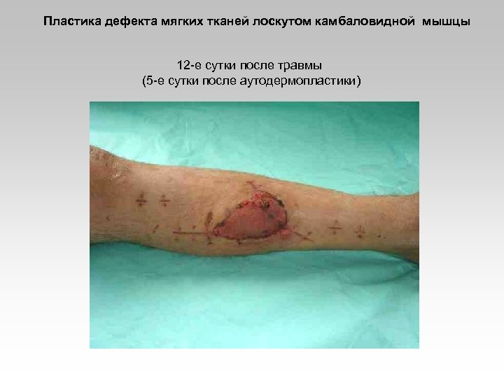 Пластика дефекта мягких тканей лоскутом камбаловидной мышцы 12 -е сутки после травмы (5 -е