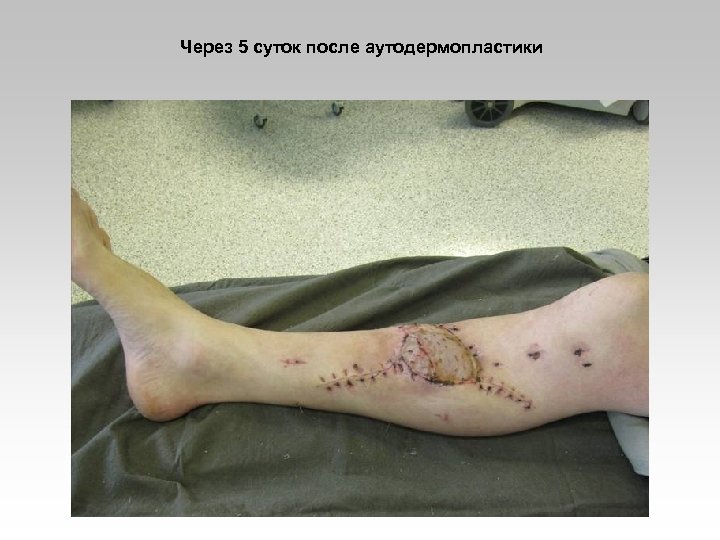 Через 5 суток после аутодермопластики 