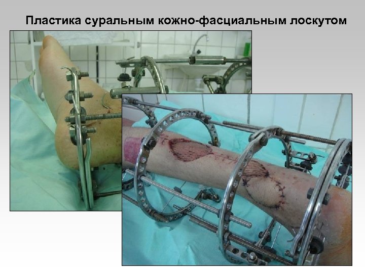 Пластика суральным кожно-фасциальным лоскутом 