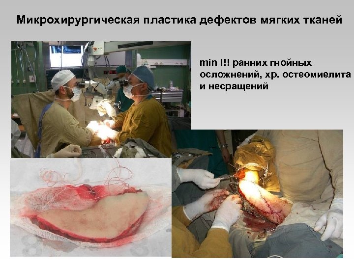 Микрохирургическая пластика дефектов мягких тканей min !!! ранних гнойных осложнений, хр. остеомиелита и несращений