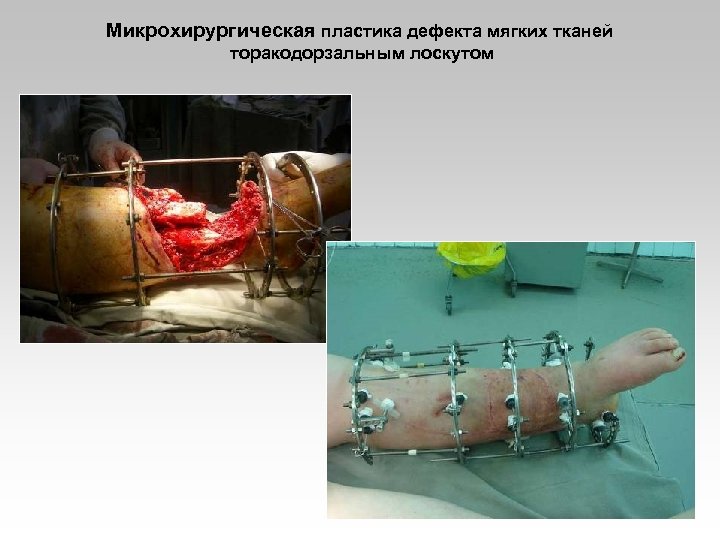 Микрохирургическая пластика дефекта мягких тканей торакодорзальным лоскутом 
