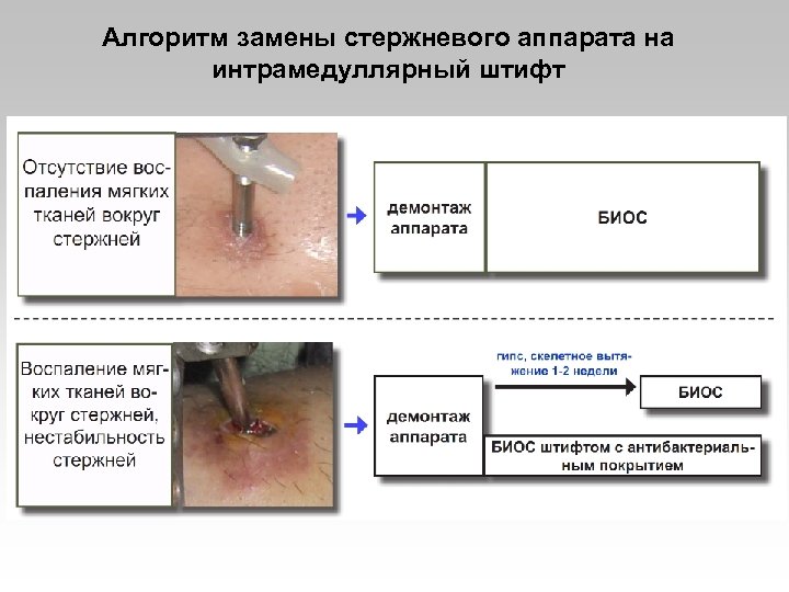 Алгоритм замены стержневого аппарата на интрамедуллярный штифт 