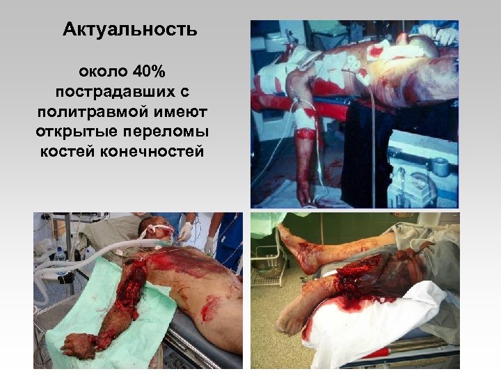 Актуальность около 40% пострадавших с политравмой имеют открытые переломы костей конечностей 