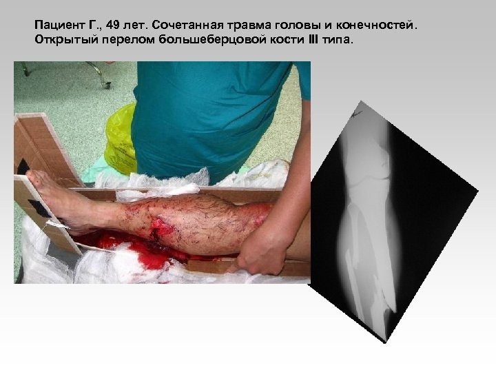 Пациент Г. , 49 лет. Сочетанная травма головы и конечностей. Открытый перелом большеберцовой кости