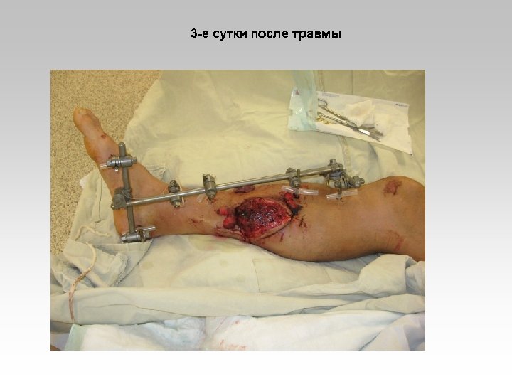 3 -е сутки после травмы 