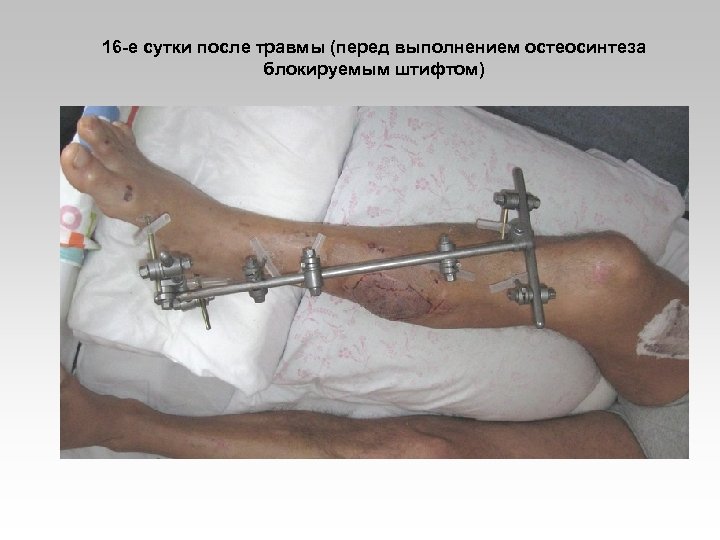 16 -е сутки после травмы (перед выполнением остеосинтеза блокируемым штифтом) 