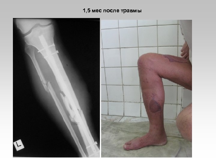 1, 5 мес после травмы 