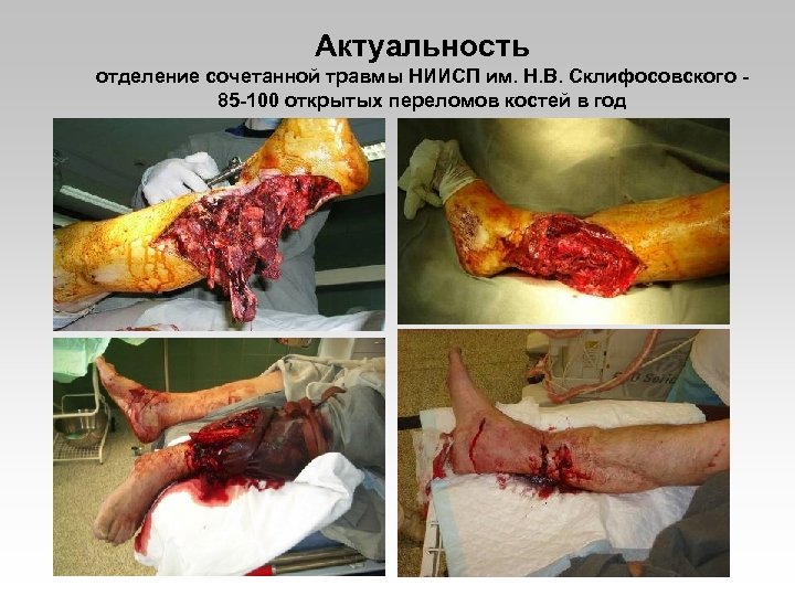 Актуальность отделение сочетанной травмы НИИСП им. Н. В. Склифосовского 85 -100 открытых переломов костей