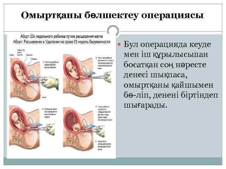 Омыртқаны бөлшектеу операциясы Бул операцияда кеуде мен іш құрылысьшан босатқан соң нәресте денесі шықпаса,