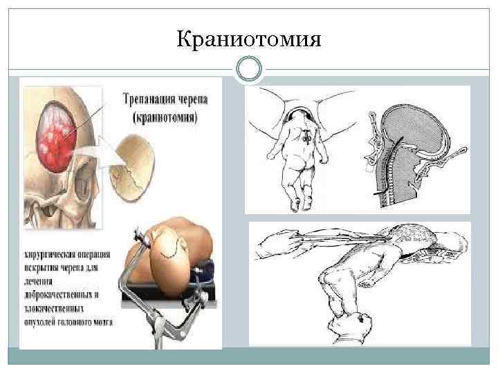 Краниотомия 