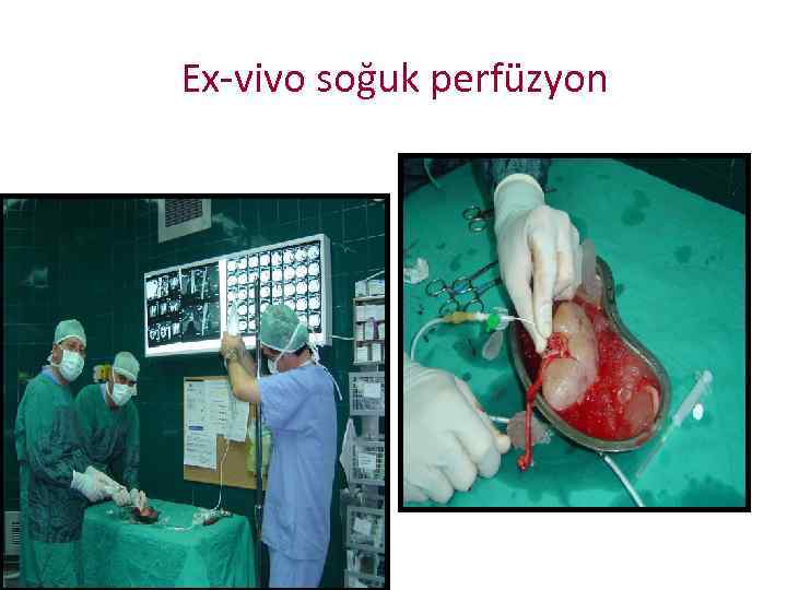 Ex-vivo soğuk perfüzyon 