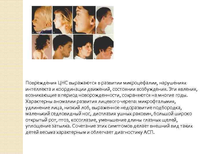 Повреждения ЦНС выражаются в развитии микроцефалии, нарушениях интеллекта и координации движений, состоянии возбуждения. Эти