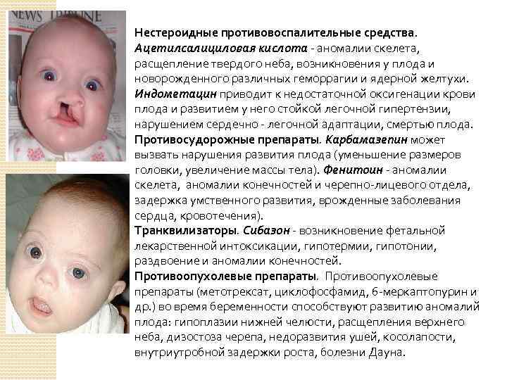 Нестероидные противовоспалительные средства. Ацетилсалициловая кислота - аномалии скелета, расщепление твердого неба, возникновения у плода