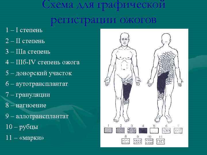 Схема для графической регистрации ожогов 1 – I степень 2 – II степень 3