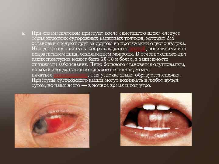  При спазматическом приступе после свистящего вдоха следует серия коротких судорожных кашлевых толчков, которые