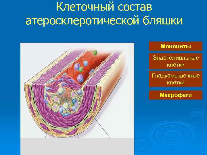 Клеточный состав атеросклеротической бляшки Моноциты Эндотелиальные клетки Гладкомышечные клетки Макрофаги 