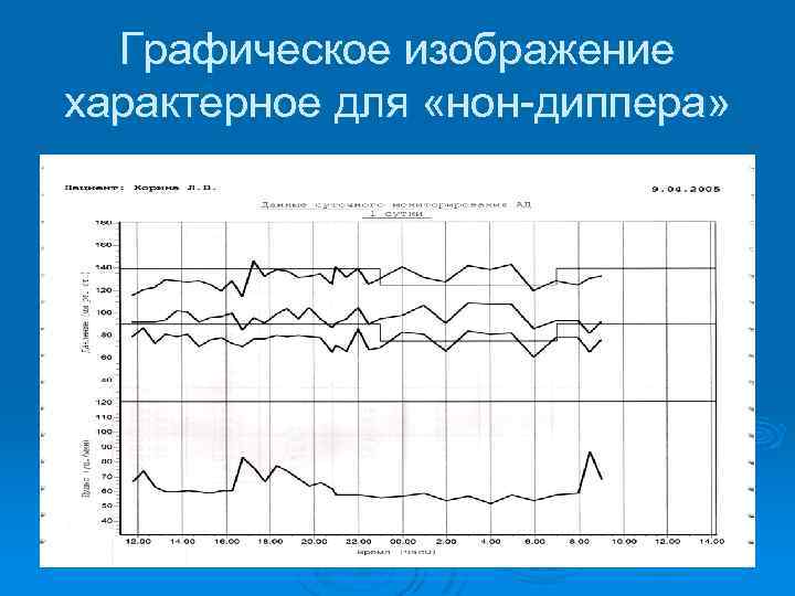 Графическое изображение характерное для «нон-диппера» 