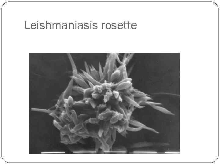 Leishmaniasis rosette 