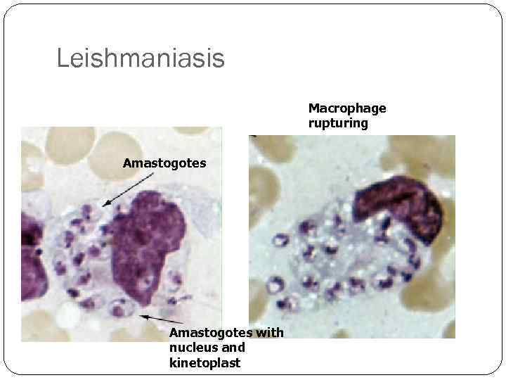 Leishmaniasis Macrophage rupturing Amastogotes with nucleus and kinetoplast 
