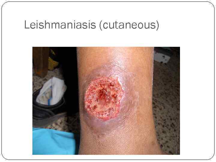 Leishmaniasis (cutaneous) 