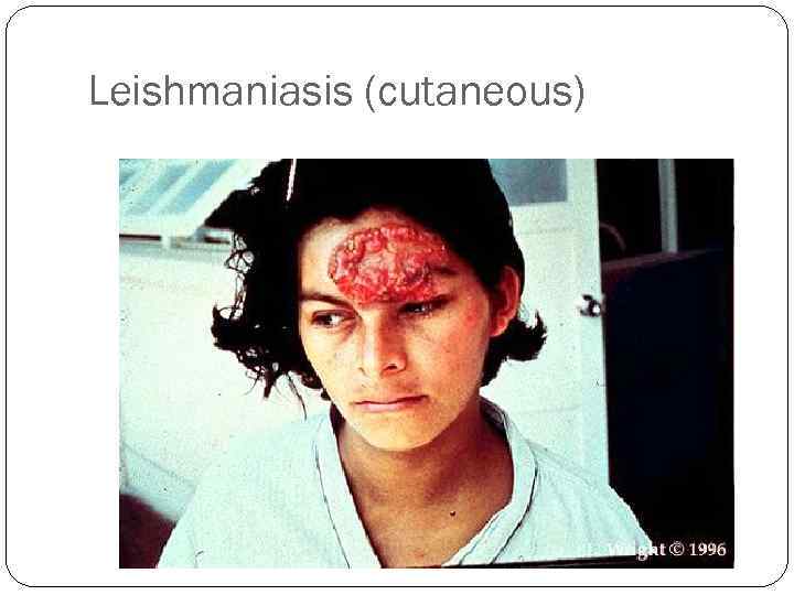 Leishmaniasis (cutaneous) 