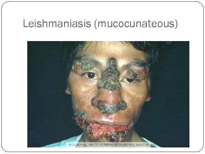 Leishmaniasis (mucocunateous) 