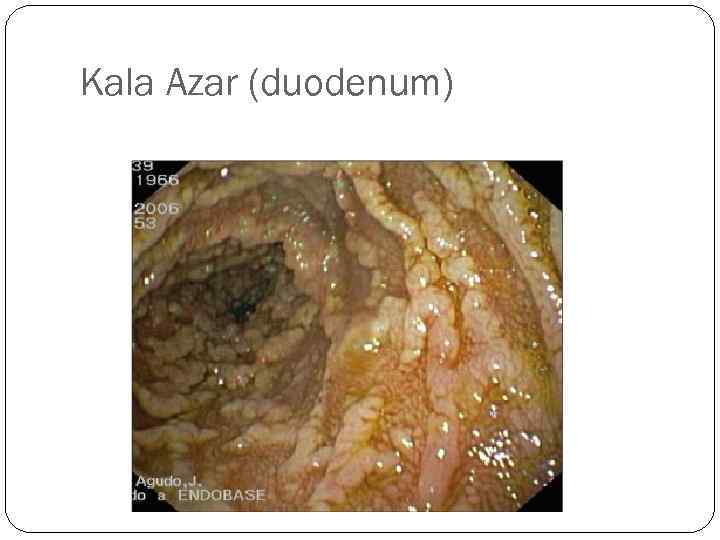 Kala Azar (duodenum) 