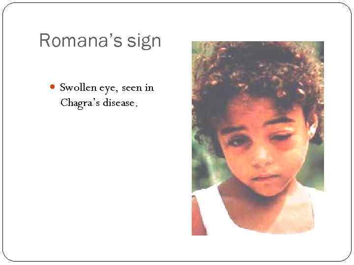 Romana’s sign Swollen eye, seen in Chagra’s disease. 