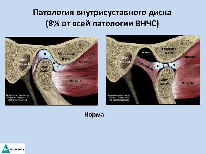 Патология внутрисуставного диска (8% от всей патологии ВНЧС) Норма 