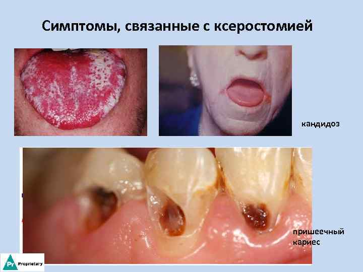 Симптомы, связанные с ксеростомией кандидоз пришеечный кариес 