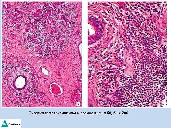 Окраска гематоксилином и эозином: а - х 60, б - х 200 