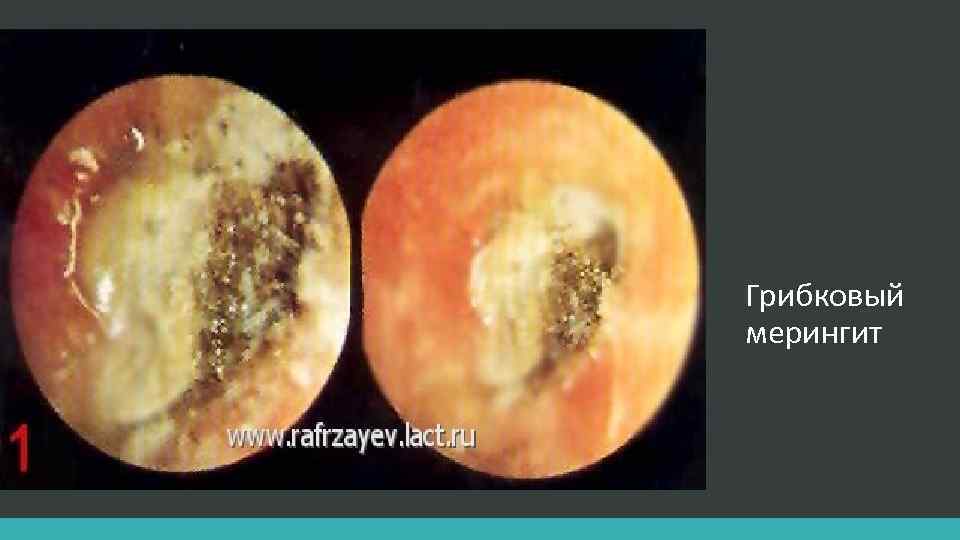 Грибковый мерингит 